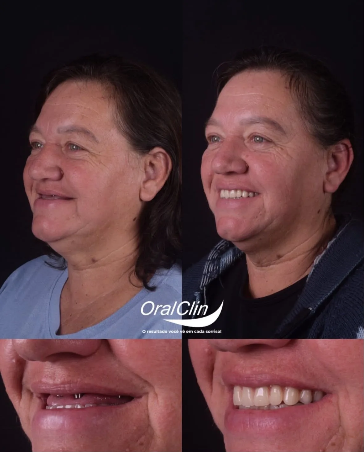 Implantes Dentários - antes e depois