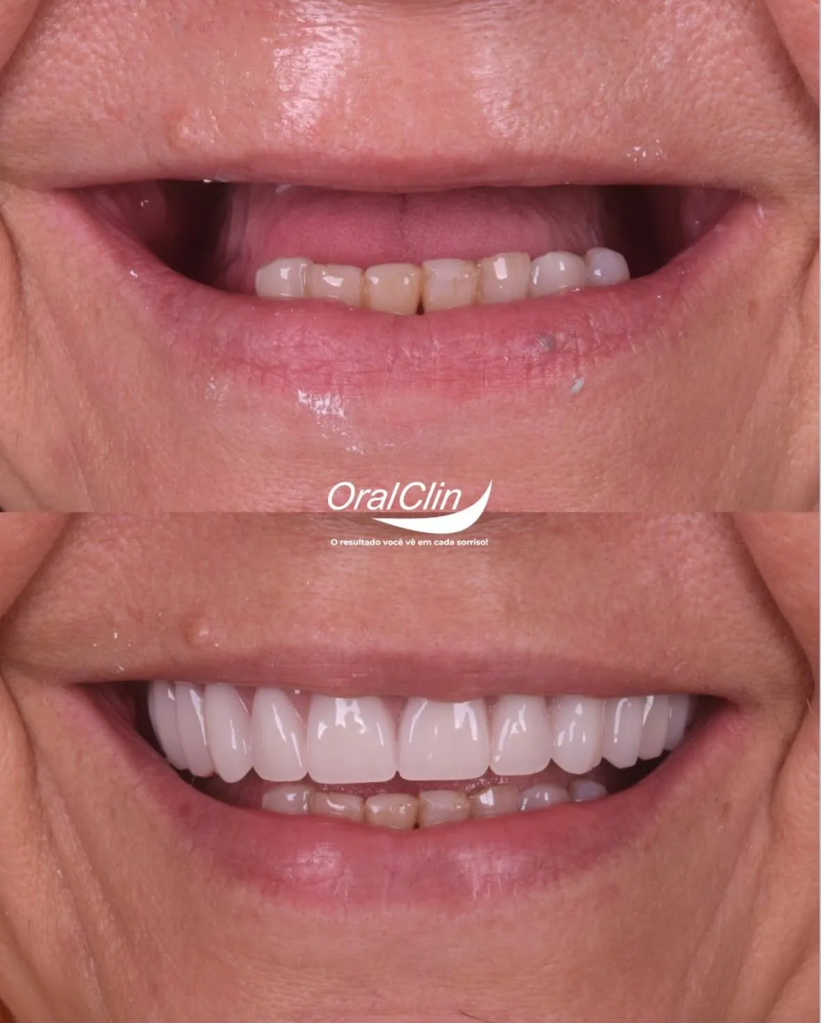 Implantes Dentários - antes e depois
