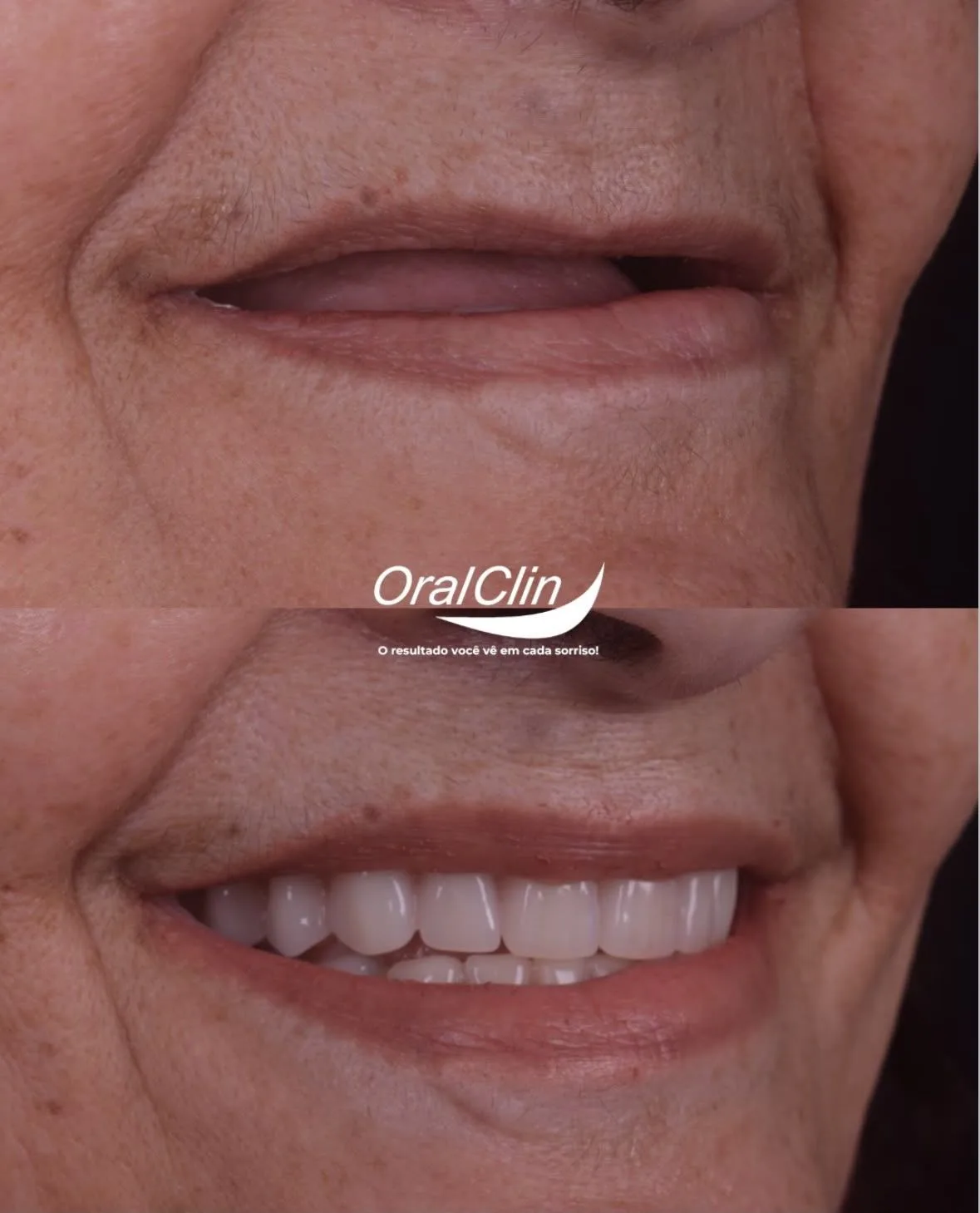 Implantes Dentários - antes e depois