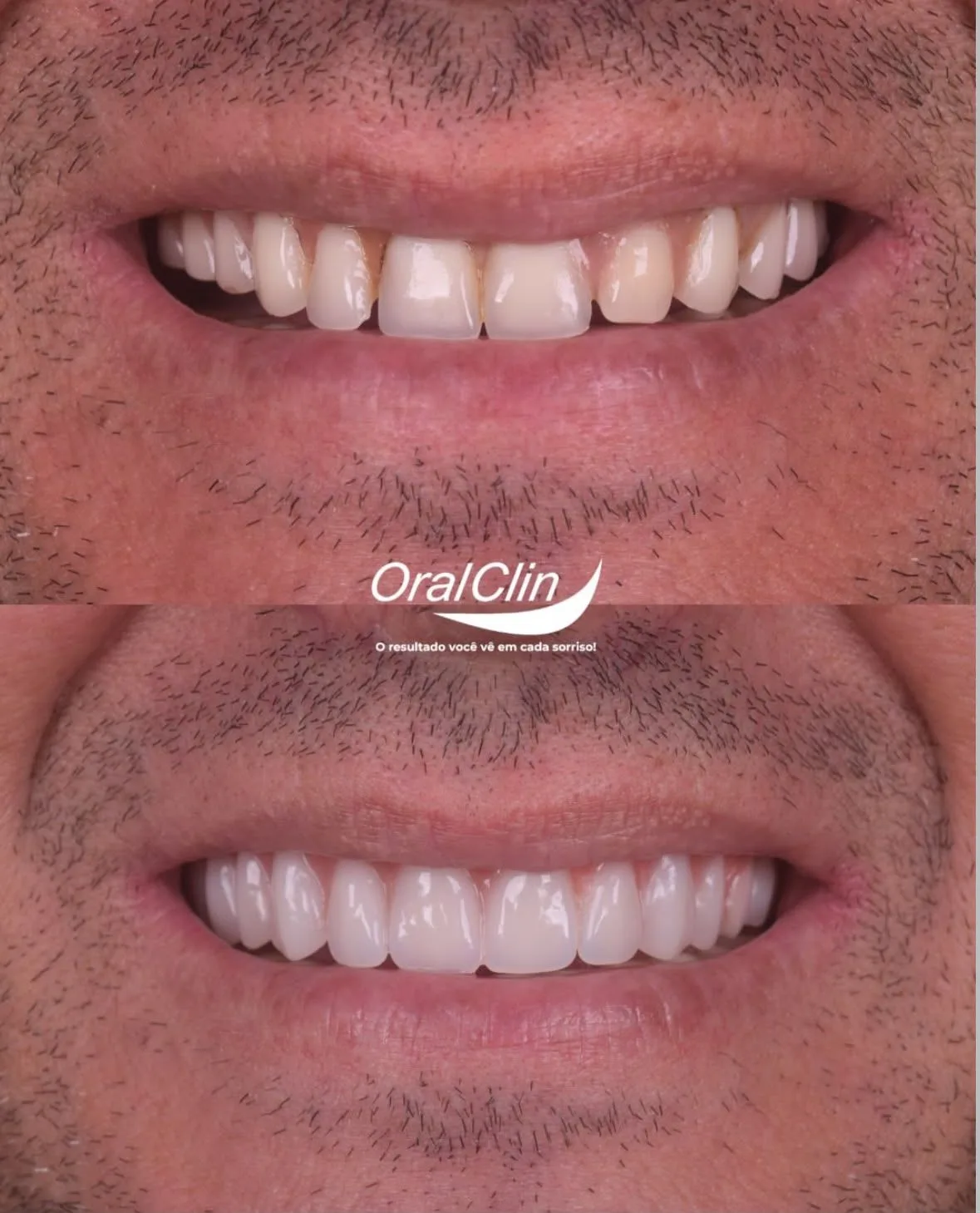 Implantes Dentários - antes e depois