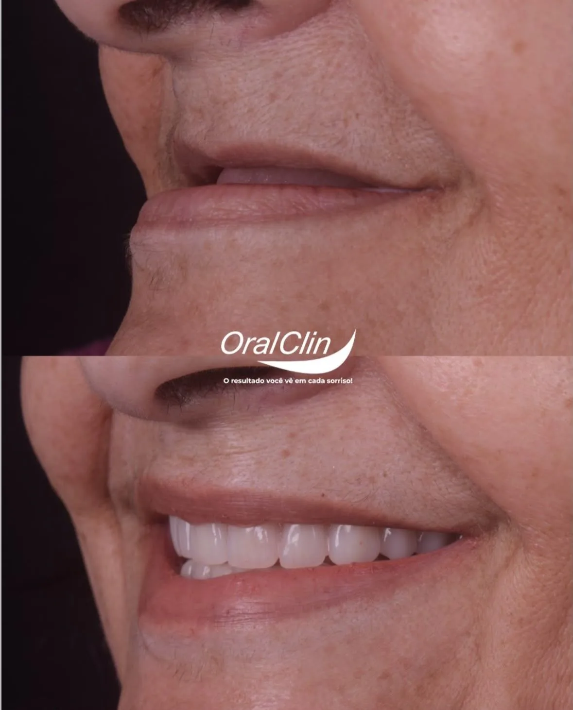 Implantes Dentários - antes e depois