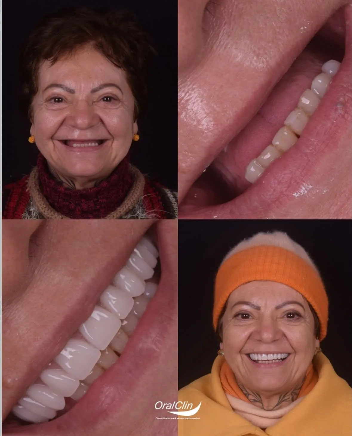 Implantes Dentários - antes e depois