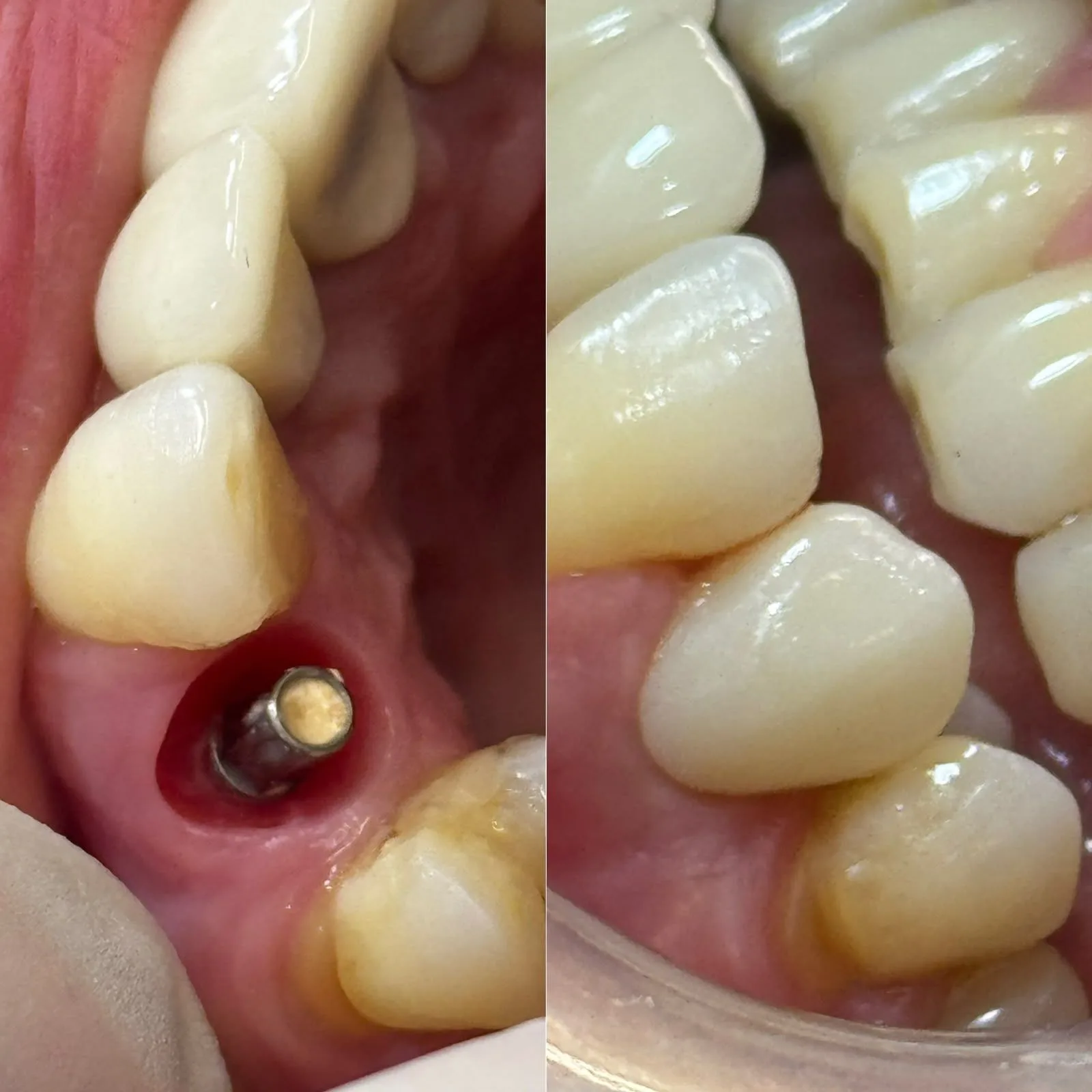 Implantes Dentários - antes e depois
