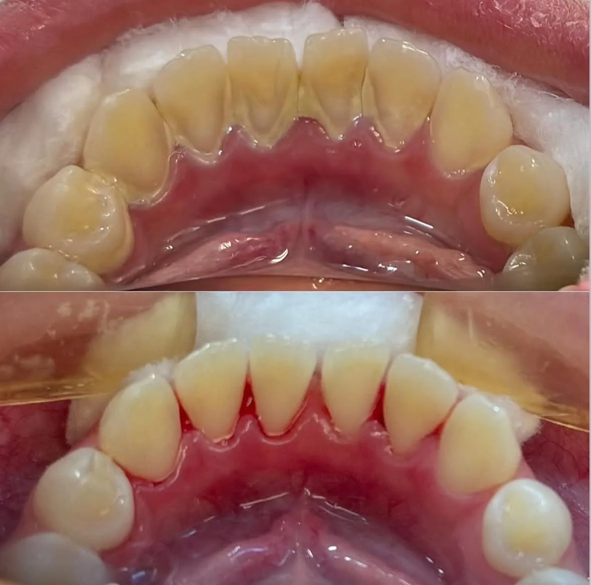 Limpeza Dental / Profilaxia - antes e depois