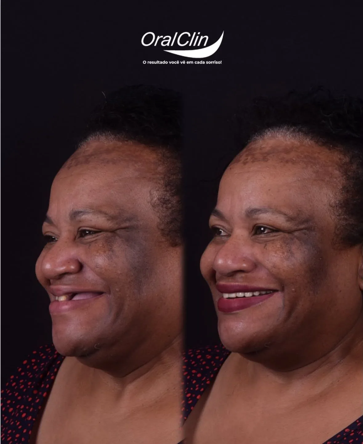 Próteses Dentárias - antes e depois