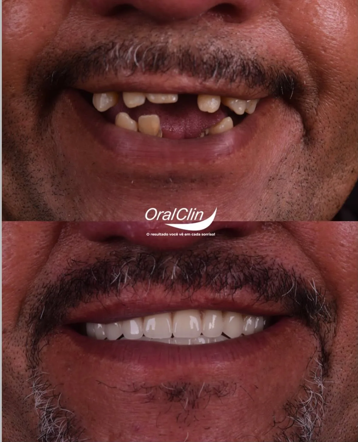 Próteses Dentárias - antes e depois