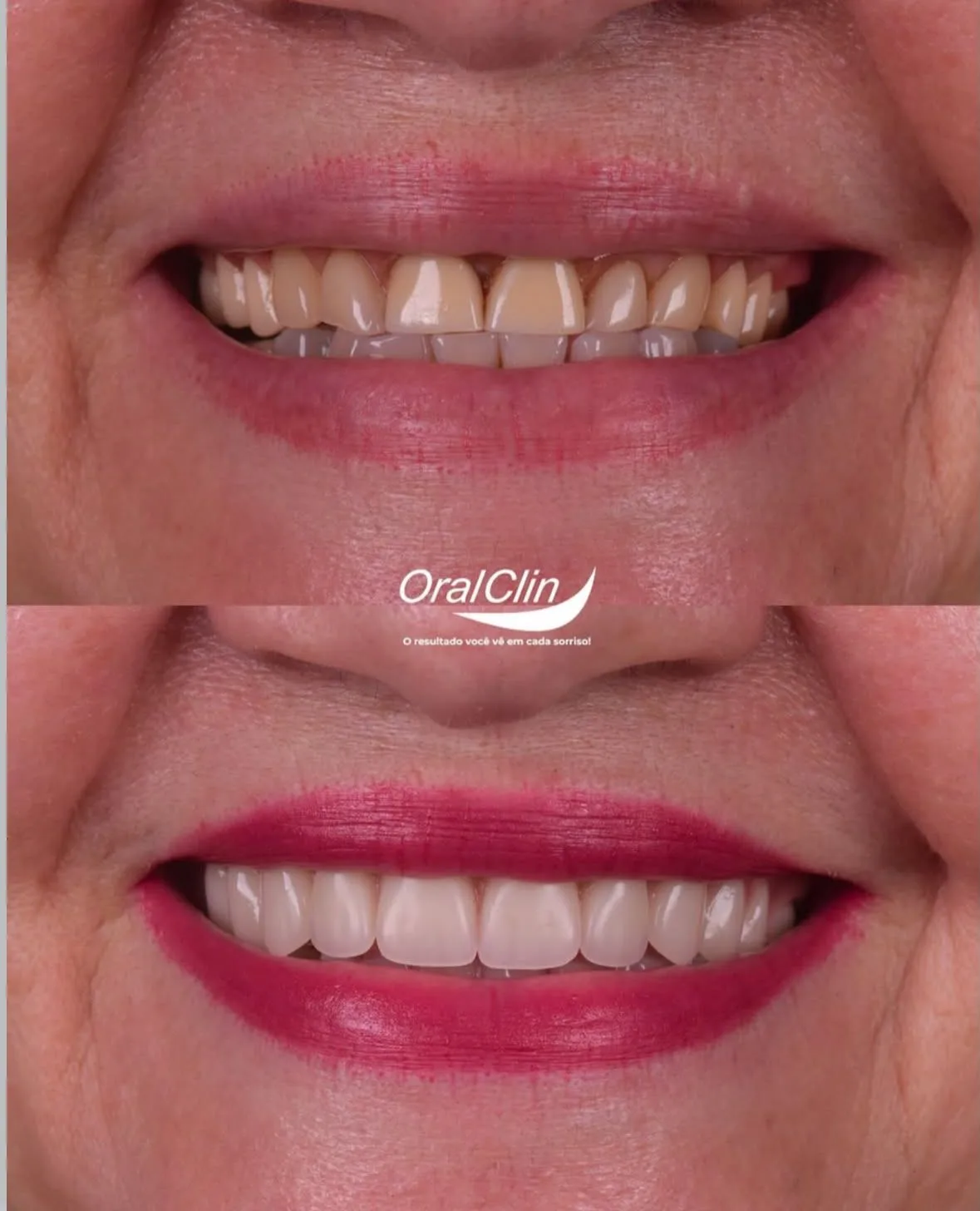Próteses Dentárias - antes e depois