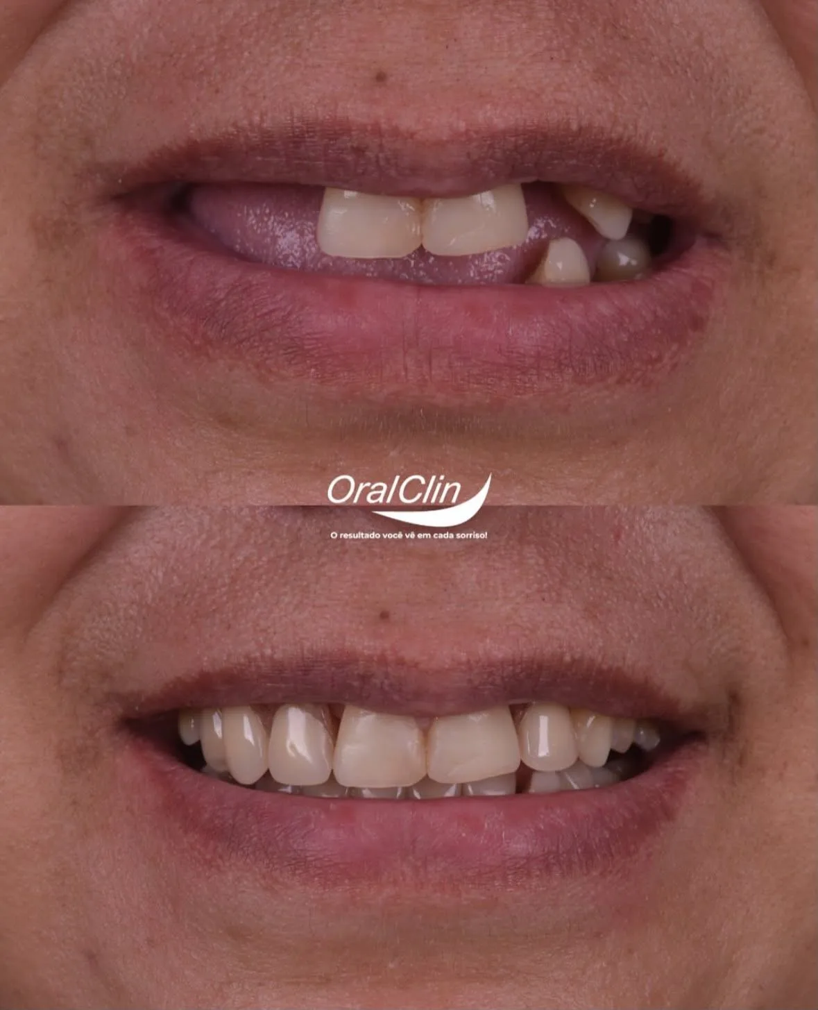 Próteses Dentárias - antes e depois
