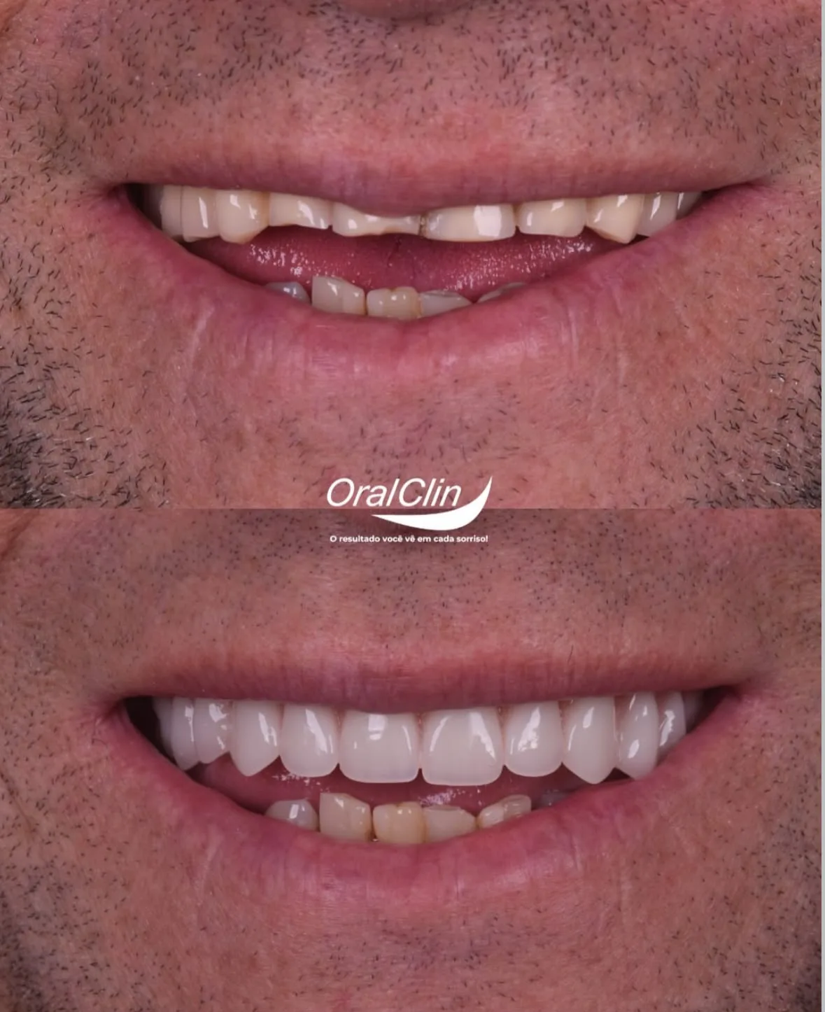 Próteses Dentárias - antes e depois