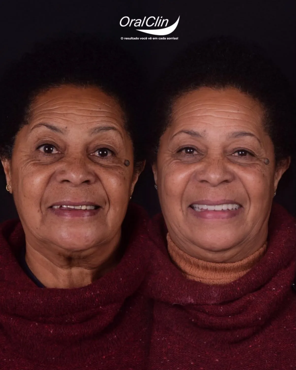 Próteses Dentárias - antes e depois