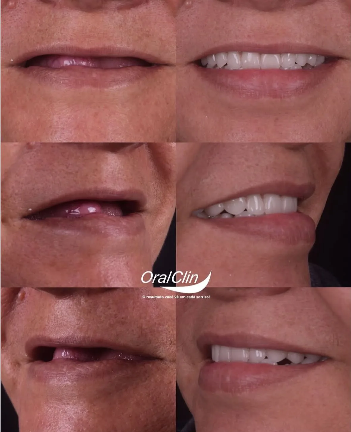 Próteses Dentárias - antes e depois