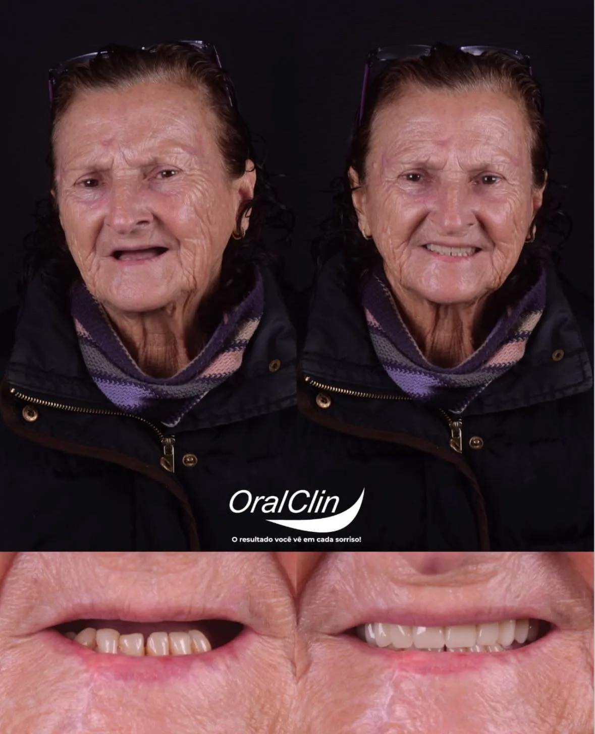 Próteses Dentárias - antes e depois