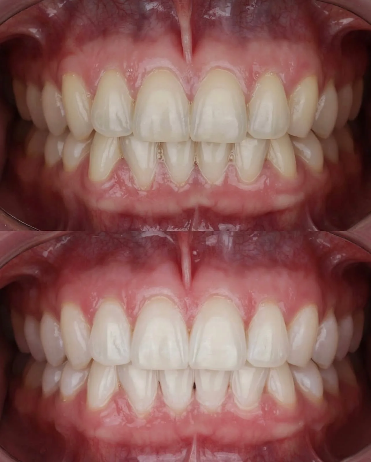 Clareamento Dental na Oral Clin