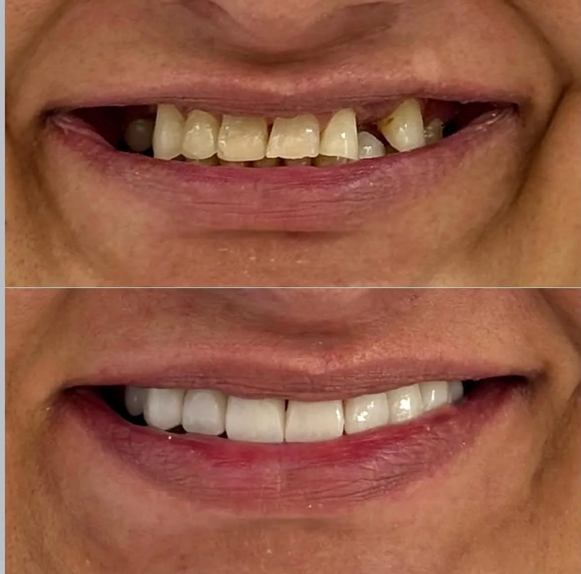 Facetas de Resina na Oral Clin