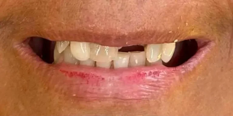 Resultado de implantes, antes do tratamento