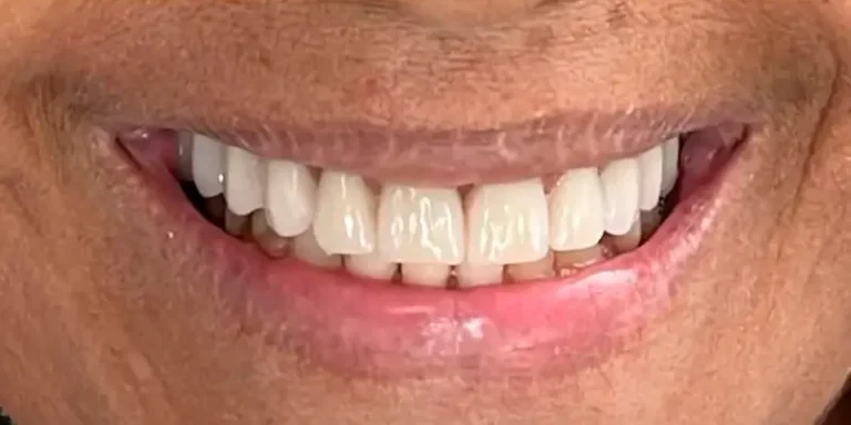 Resultado de implantes, depois do tratamento