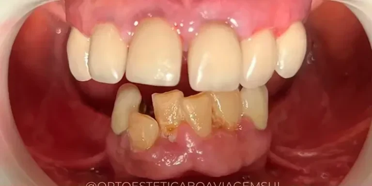 Resultado de implantes, antes do tratamento