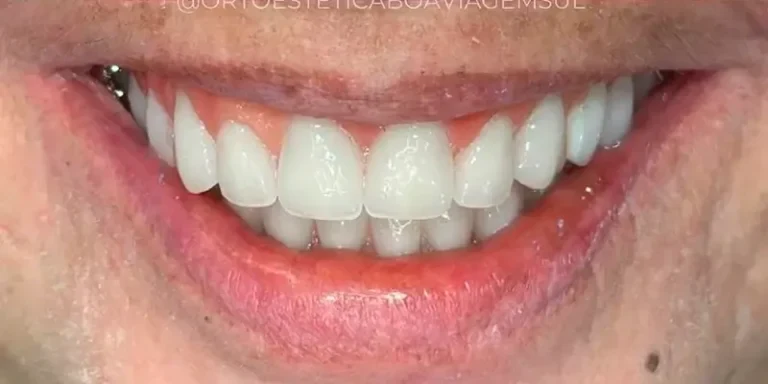 Resultado de implantes, depois do tratamento