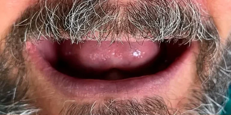 Resultado de implantes, antes do tratamento