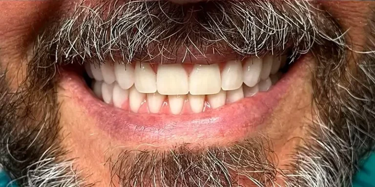 Resultado de implantes, depois do tratamento