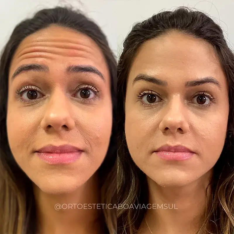 Resultado Botox
