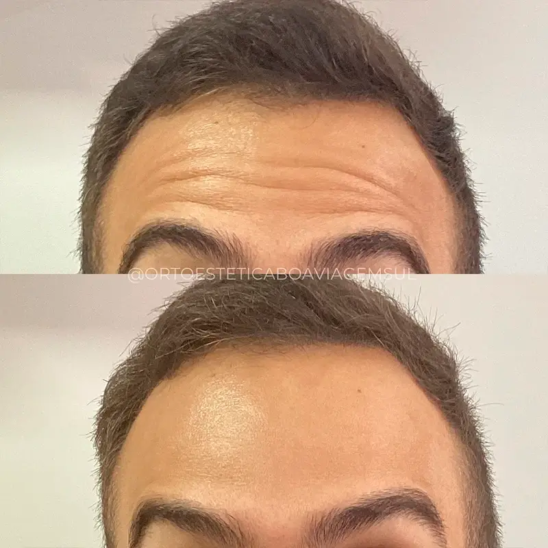 Resultado Botox