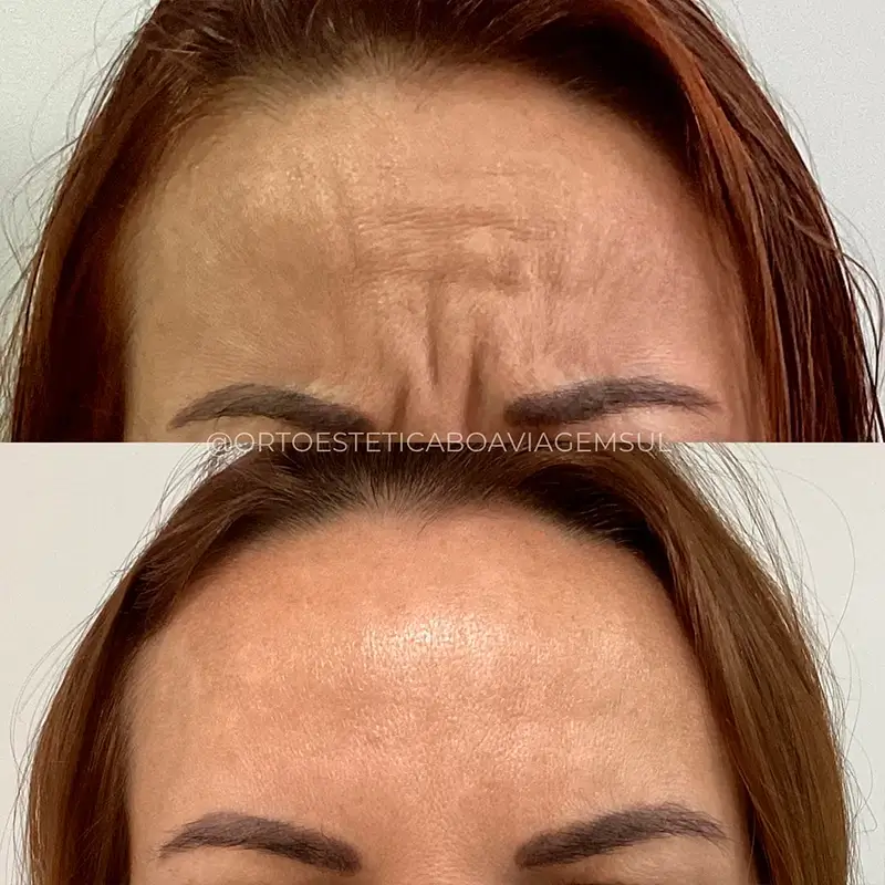 Resultado Botox
