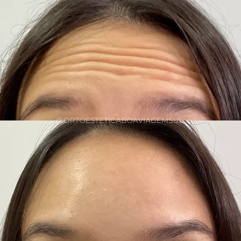 Resultado Botox