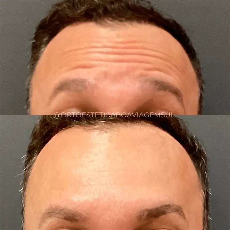 Resultado Botox