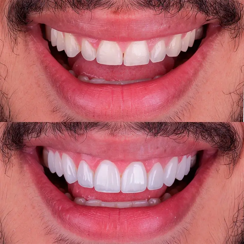 Facetas em Resina