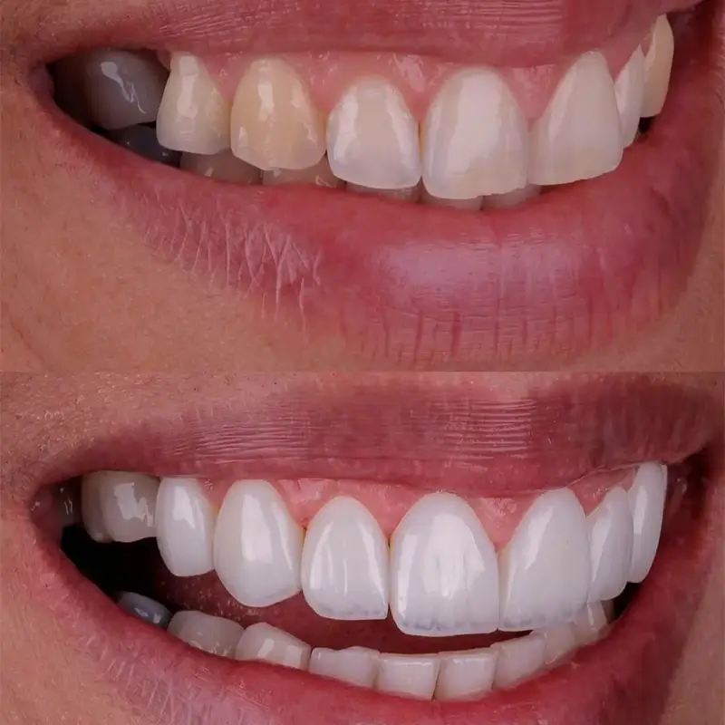 Resultado Facetas em Resina