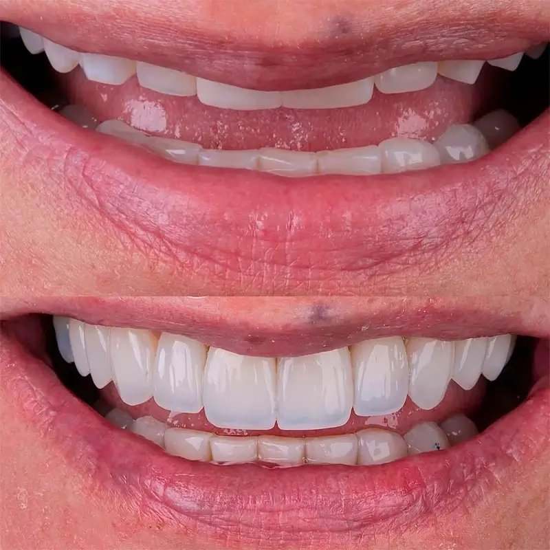 Resultado Facetas em Resina
