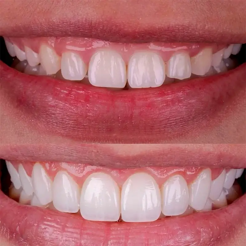 Resultado Facetas em Resina