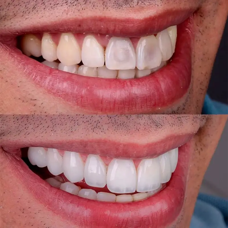 Resultado Facetas em Resina