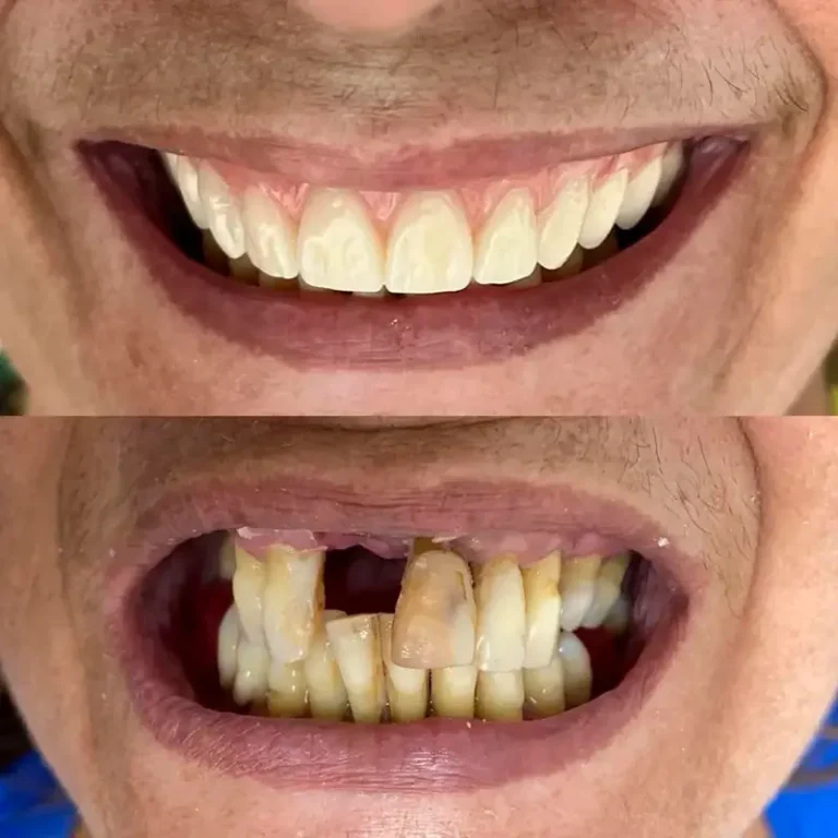 Resultado Implantes Dentários