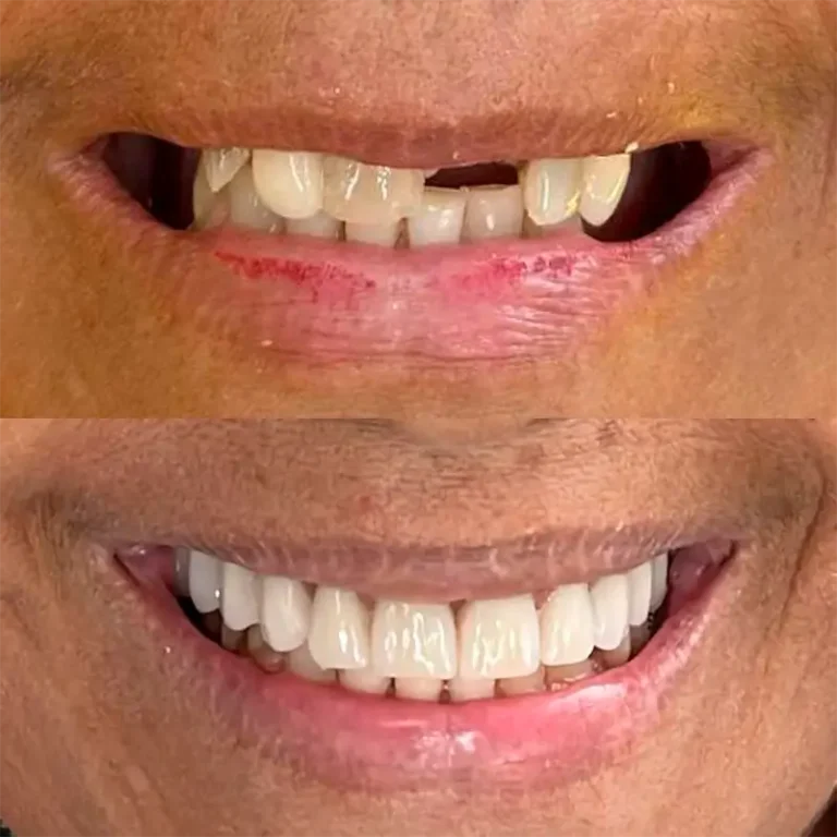 Resultado Implantes Dentários