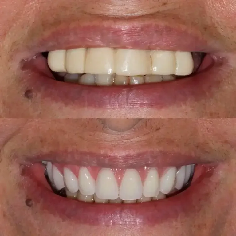 Resultado Implantes Dentários