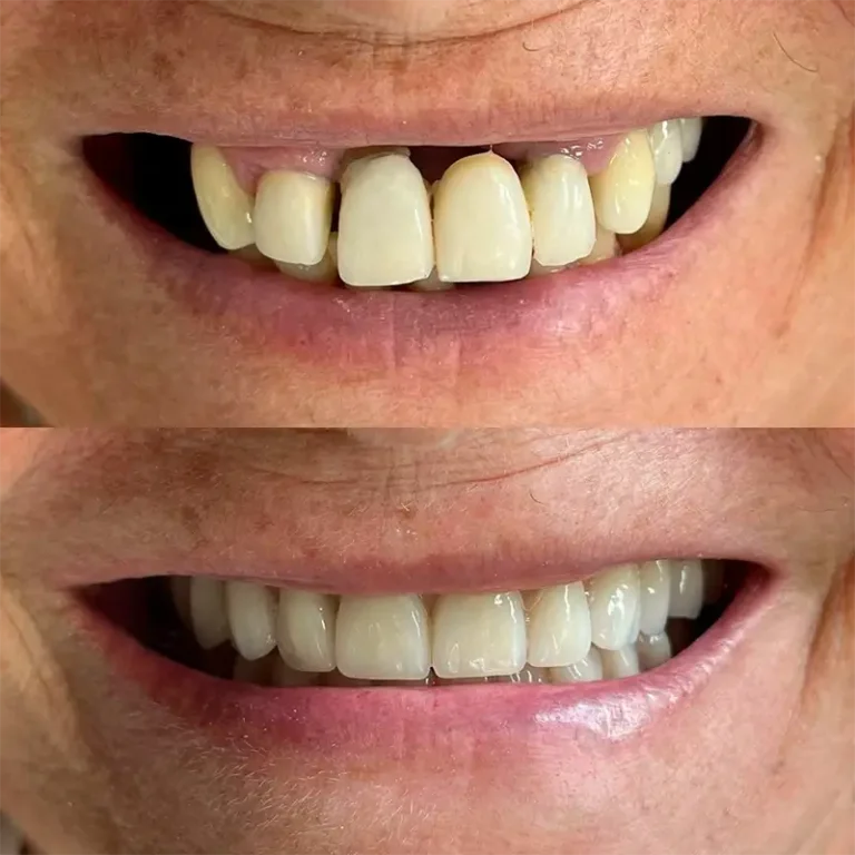 Resultado Implantes Dentários