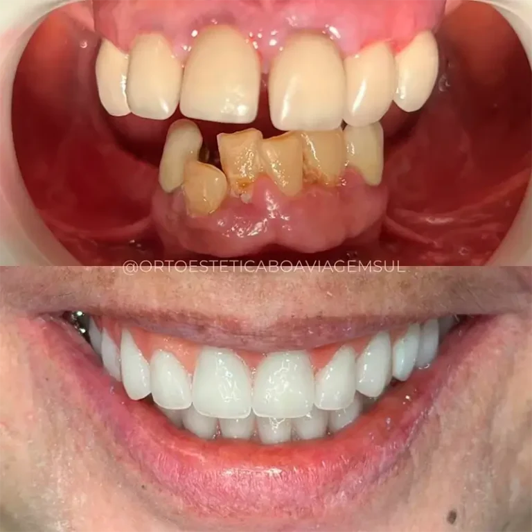 Resultado Implantes Dentários