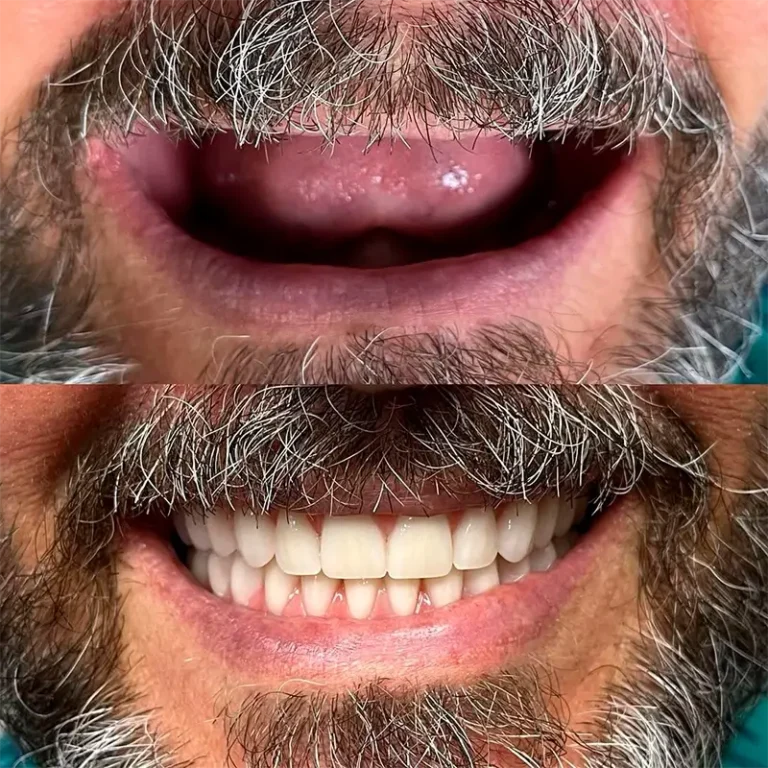 Resultado Implantes Dentários