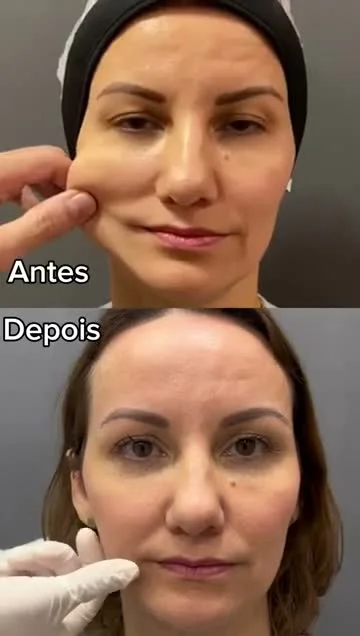 Vídeo Bioestimulador de Colágeno