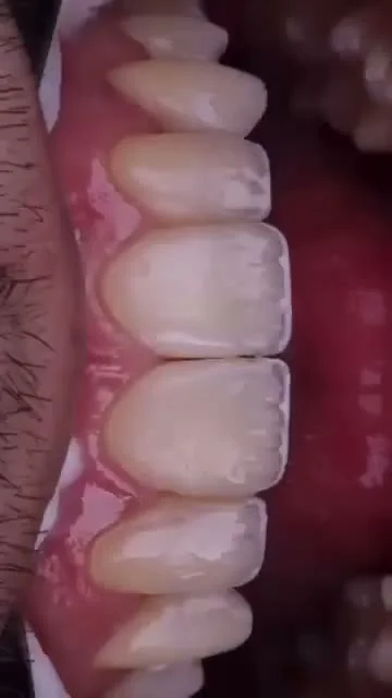 Vídeo Facetas em Resina