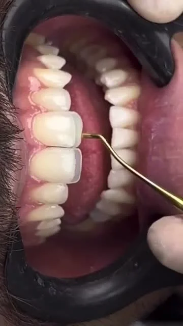 Vídeo Facetas em Resina