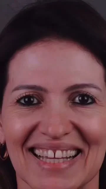 Vídeo Facetas em Resina