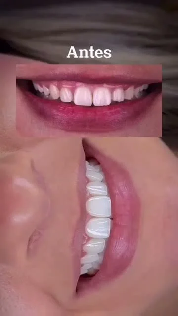 Vídeo Facetas em Resina
