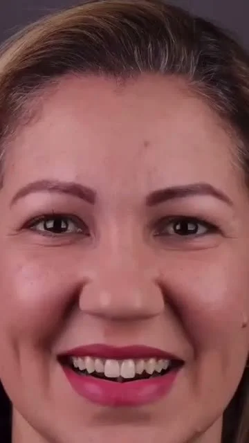 Vídeo Facetas em Resina