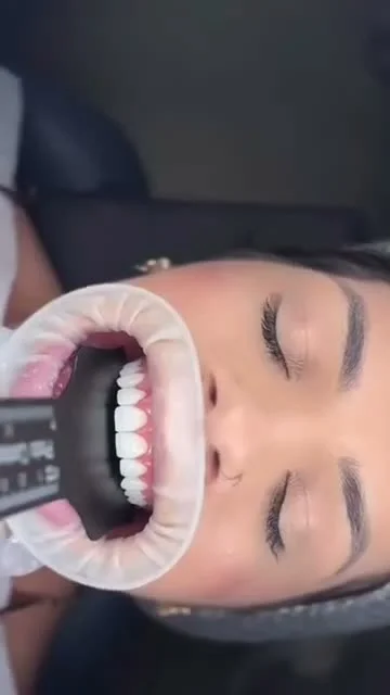 Vídeo Facetas em Resina