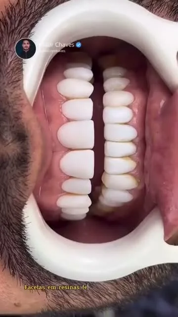Vídeo Facetas em Resina
