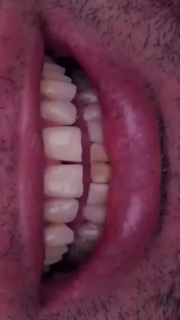 Vídeo Facetas em Resina