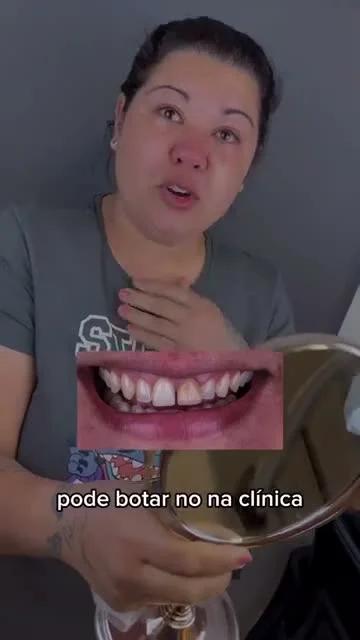 Vídeo Facetas em Resina